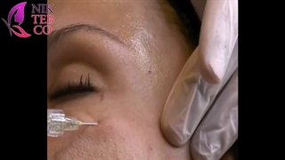 تزریق فیلر پرفکتا زیر چشم