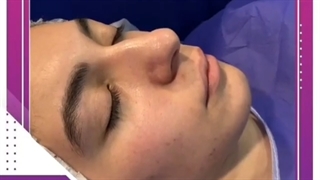 فیلم بدون سانسور و واقعی جراحی بینی در اتاق عمل قبل و بعد از عمل بینی