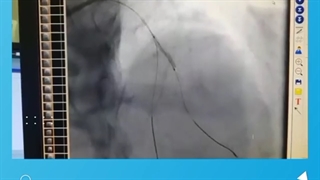 استنت گذاری تنگی دوشاخه رگ کرونر با تکنیک مینی کراش.