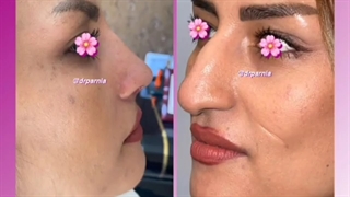 جراحی زیبایی بینی