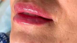 تخلیه ژل پاژ