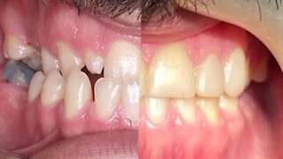 ارتودنسی بزرگسال توسط دکتر نگار حدادی درمان سلولیت