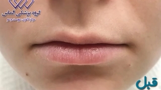 فیلم تزریق فیلر لب به صورت نچرال