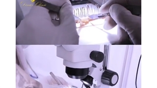 نمونه قبل و بعد کاشت ابروی طبیعی