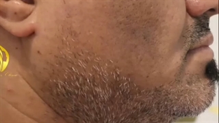 فیلم قبل و بعد کاشت ریش