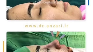 نمونه کار جراحی بینی در اتاق عمل