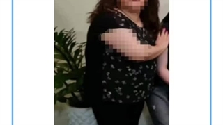 تصاویر قبل و بعد از عمل چاقی