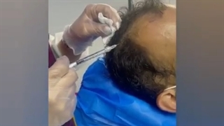 مزوتراپی سر