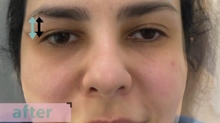 لیفت شقیقه یکطرفه