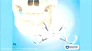 درمان ارتودنسی با جراحی سارپه |  | دکتر حمید قاسمی