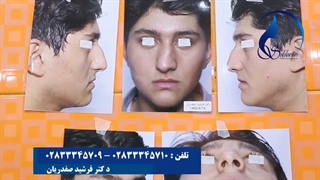 عمل بینی استخوانی