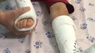 فیلم تجربه واقعی از جراحی کودک فلج مغزی