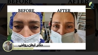 یک هفته بعد از بلفاروپلاستی