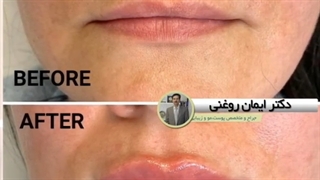 تزریق ژل لب