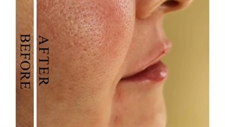 بعد از تزریق ژل برای سه ناحیه زیر چشم ، لب و خط غم