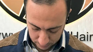 کاشت مو با خط رویش طبیعی | کاشت FUT روش بسیار پیشرفته‌ برای پیوند مو زیبایی پوست
