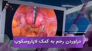 خارج کردن رحم به وسیله لاپاراسکوپ