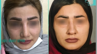 انجام جراحی بینی برای زیباجوی عزیز توسط دکتر پژمان سرشارزاده