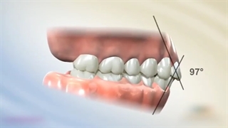 تاثیر ارتودنسی روی لب ها،متخصص ارتودنسی دکتر علیرضا خدیوی
