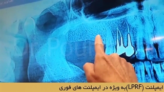ایمپلنت فوری