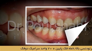 ارتودنسی دندان + ۲۰ واحد سرامیک دوفک