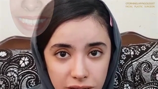 اصلاح انحراف شدید و در رفتگی تیغه بینی