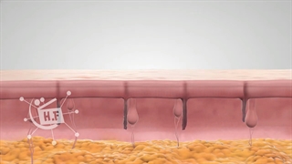 از بین رفتن موهای زائد بوسیله لیزر