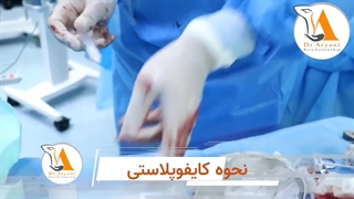 نحوه کایفوپلاستی