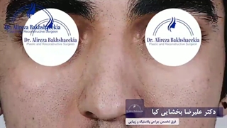 جراحی زیبایی بینی