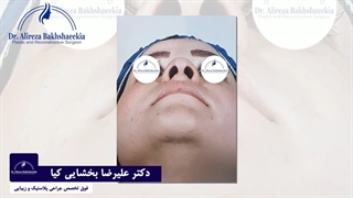 جراحی زیبایی بینی