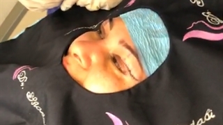 بلفاروپلاستی پلک بالا