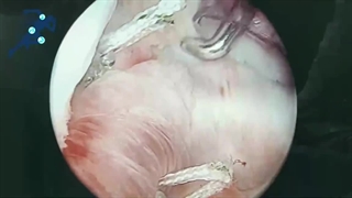 ترمیم آرتروسکوپیک لبروم شانه| دکتر شیروانی بختیاری