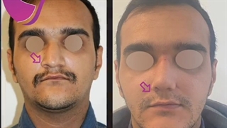 فیلم واقعی و بدون سانسور عمل بینی مردانه
