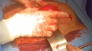 فیلم واقعی جراحی برداشتن رحم خانم ۴۵ ساله