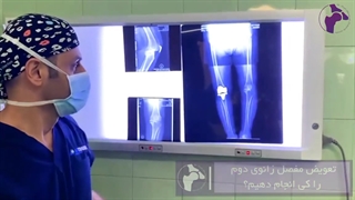 تعویض مفصل زانوی دوم را کی انجام دهیم؟