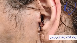 فیلم جراحی اندوسکوپیک