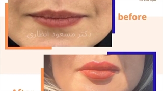 تزریق ژل به لب