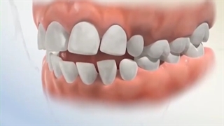 نگهدارنده زبان فک پایین.متخصص ارتودنسی دکتر علیرضا خدیوی