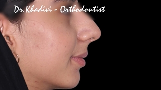 نمونه درمان ارتودنسی همراه با کشیدن دندان در فک بالا.متخصص ارتودنسی دکترعلیرضاخدیوی