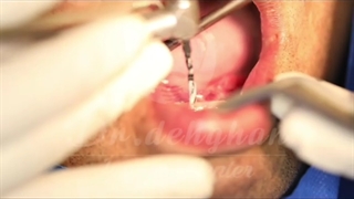 دکتر وحید دهقان:  کاشت فول فک پایین