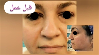 انجام عمل بینی همراه با رفع مشکل تنفسی و انحراف بینی