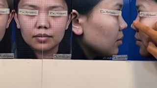 عمل بینی آسیایی برای دختر خانم افغان