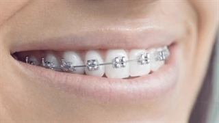 برای منظم کردن دندان ها، ارتودنسی یا درمان های زیبایی؟