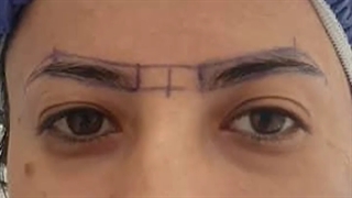 نمونه ای از کاشت ابرو و بلفاروپلاستی کلینیک گلبان