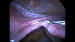 جراحی فیبروم