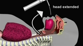 اینتوباسیون