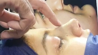 جراحی بینی با اصلاح انحراف بینی | دکتر ابراهیمی
