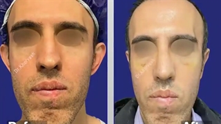 ده روز بعد از عمل بینی و گوش | دکتر خوروش