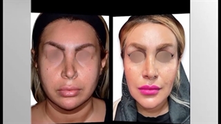 پروتز چانه ، ساکشن گردن و تخلیه چربی بوکال | دکتر خوروش