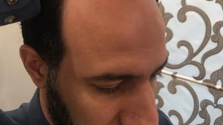 کاشت مو طبیعی